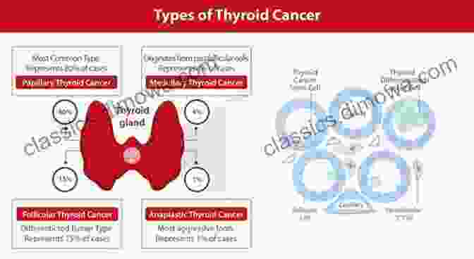 Diagram Showing Different Types Of Thyroid Cancer Thyroid Randy Porter